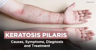 Image result for Keratosis pilaris