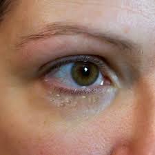 How To Get Rid Of Milia Under The Eye Ehow Bumps Under Eyes Forehead Acne Better Skin