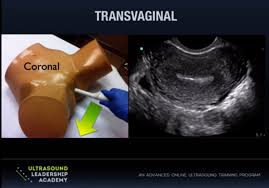 2 additional black & white pictures (5 total) 1 color picture. Ultrasound Leadership Academy Ultrasound In Early Pregnancy Em Curious