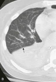 Image result for Air Bronchogram