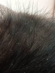 Image result for lice vs dandruff