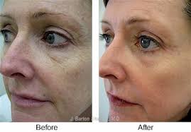 If you are going to use at home products. Chemical Peel Laser Skin Treatments J Barton Sterling Md