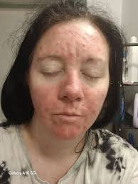 Has anyone had success with Rhofade or Emrosi for rosacea?