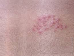 Image result for shingles in children