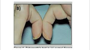 Image result for Clubbing nails feet