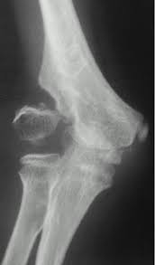 Image result for Lateral Condyle Fracture