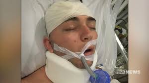 Australian tourist injured in Bali scooter crash improves after emergency  surgery