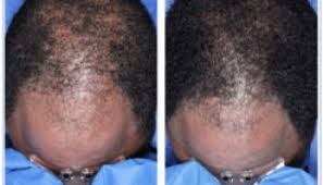 Facial hair growth increased hair loss inflammation or soreness at root of hair reddened skin swelling of face signs and symptoms of too much medicine being absorbed into the body—rare. Minoxidil Vs Male Pattern Baldness A Scientific Review