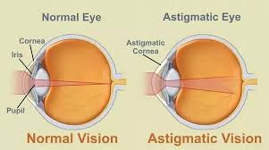 Maybe you would like to learn more about one of these? What Causes Permanent Blurred Vision In One Eye Quora