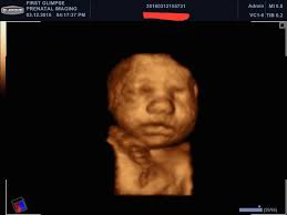 March 3D/HD Pictures — First Glimpse Prenatal Imaging
