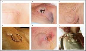 Image result for Cardiac Pacemaker Infection