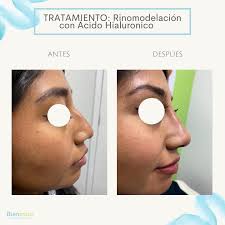 ✨Rinomodelación💉✨ ◾️Duración: 9-12 meses. ◾️Producto: Ácido hialurónico.  👩🏻‍⚕️Dra.Mayte Álvarez  #medicinaestetica#acidohialuronico#rinomodelacion#narizperfectasincirugia#fillers#fillersinjection#oaxaca#bienestar#
