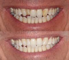 There are a number of times where extraction is the most appropriate treatment option though, and we are here to assist patients with: White Fillings Mercury Free Composite Resin Hobsonville Point Denta White Fillings Filling Dental