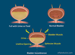 Bladder Sphincter Dyssynergia Or Neurogenic Detrusor Overactivity Causes Symptoms Treatment