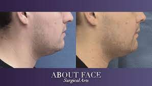 Jaw surgery is generally safe when done by an experienced surgeon. Jaw Orthognathic Surgery About Face Surgical Arts