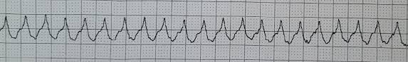 An umbrella term used to describe tachycardias. Svt With Aberrancy Or Ventricular Tachycardia Acls Medical Training