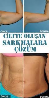 Ciltte Olusan Sarkmalara Cozum Cilt Bakimi Saglik Yaslanma
