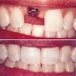 Dental Implants product image