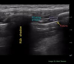 Image result for Pulmonary Contusion