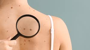 Causes of cherry angioma cherry angioma is caused by dilation and proliferation of endothelial cells that line the blood vessels. This Is Why You Have Red Marks On Your Skin And When You Should Get Worried