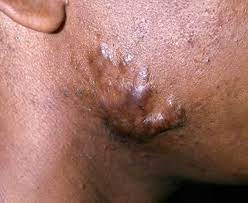 How to get rid of keloid scars. Keloid Causes Of Keloid Scar On Face Prevention Treatment