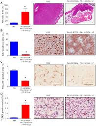 It is the second most prevalent type of lung cancer after lung adenocarcinoma and it originates in the bronchi. Plos One Efficient Targeting Of Head And Neck Squamous Cell Carcinoma By Systemic Administration Of A Dual Upa And Mmp Activated Engineered Anthrax Toxin