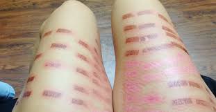 Laser hair removal does require a series of treatments, typically at least 8 and facial hair may need maintenance treatments 1 to 2 times a year after completing a series just to keep the ingrowns at bay. Contraindications And Effects Of Laser Hair Removal Is Harmful To Health