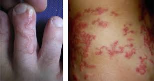 Image result for Hookworm