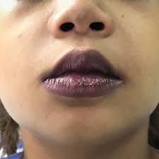 ازرقاق الشفاه تعرف على كافة الأسباب وطرق العلاج ويب طب