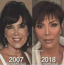 13 Plastic Surgery Before And After Photos Amazing Nowaygirltv Plastic Surgery Celebrity Plastic Surgery Facial Plastic Surgery