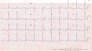 Myocarditis is an inflammatory disease of the myocardium that may present with sudden cardiac death, symptoms mimicking myocardial infarction, heart rhythm and conduction disorders, and heart failure. Causes And Management Of Myocarditis Rcemlearning