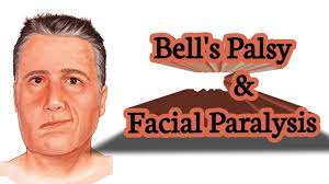Research shows bell's palsy afflicts approximately 40,000 americans every year. Bells Palsy Exercise Treatment Of Facial Paralysis