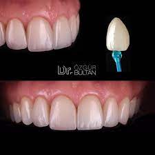 Emax Laminate Veneer Smiledesign Estheticdentistry Dentalphotography Cosmeticdentistry Dentist De Dental Photography Dental Veneers Esthetic Dentistry