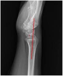 Image result for Wrist XRay