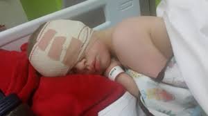 An early sign of childhood eye cancer is a white glow in the pupil Little Boy Has Eye Removed After Dad Spots Rare Cancer Sign In Photo