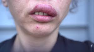 We did not find results for: 7 Penyebab Bibir Bengkak Tiba Tiba Berbahayakah