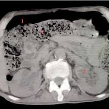 La péritonite désigne une inflammation aiguë du péritoine, membrane recouvrant la cavité péritonite : Pdf Une Peritonite Asthenique Par Perforation Stercorale