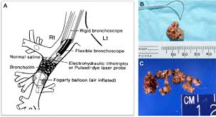 Image result for Broncholithiasis