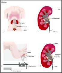 Lithotripsy Procedure Test Blood Tube Pain Complications Time Pregnancy