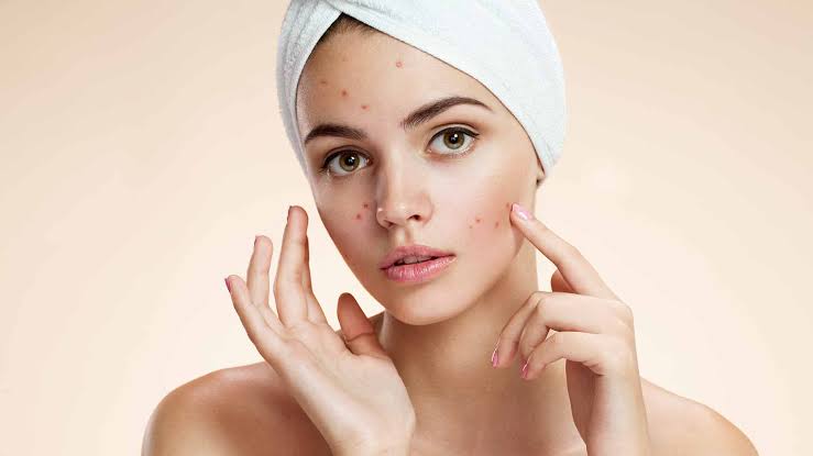 Image result for skin pimples