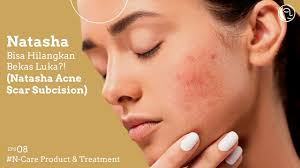 Natasha Bisa Hilangkan Bekas Luka?! (Natasha Acne Scar Subcision)