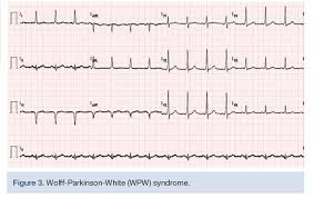 Image result for R Wave