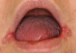 Image result for Angular Stomatitis
