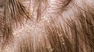 Image result for sores on the head in children