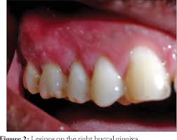 Mouth sores are a common complaint, and they can occur for a variety of reasons, including irritation, hormonal changes, and infection. Figure 2 From Acute Herpetic Gingivostomatitis Associated With Herpes Simplex Virus 2 Report Of A Case Semantic Scholar