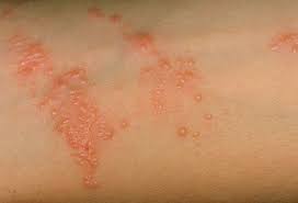 Bootswebmd Gp Reviewed Health Information For The Uk Skin Rashes Pictures Poison Ivy Rash Rashes Remedies