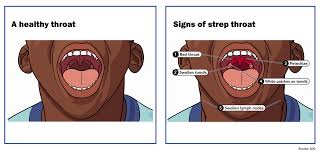 Image result for Strep throat infection roof of mouth