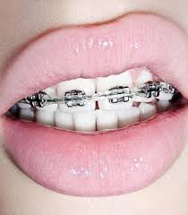 Black And Pink Braces Posts About Pinterest Rants On Designtrolls Pink Braces Braces Colors Cute Braces Colors