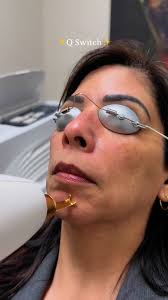 Glow up with Q-Switch! ✨ Targeting...