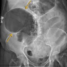 Usmle Pathology Slides Pathology Abdominal Distension Human Body Anatomy